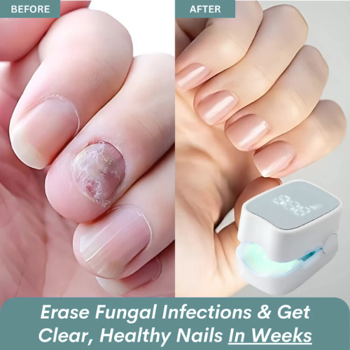 Walimo Pro™ - Nail Fungus Laser Device