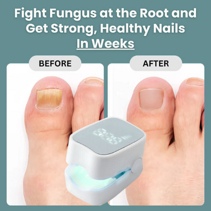Walimo Pro™ - Nail Fungus Laser Device