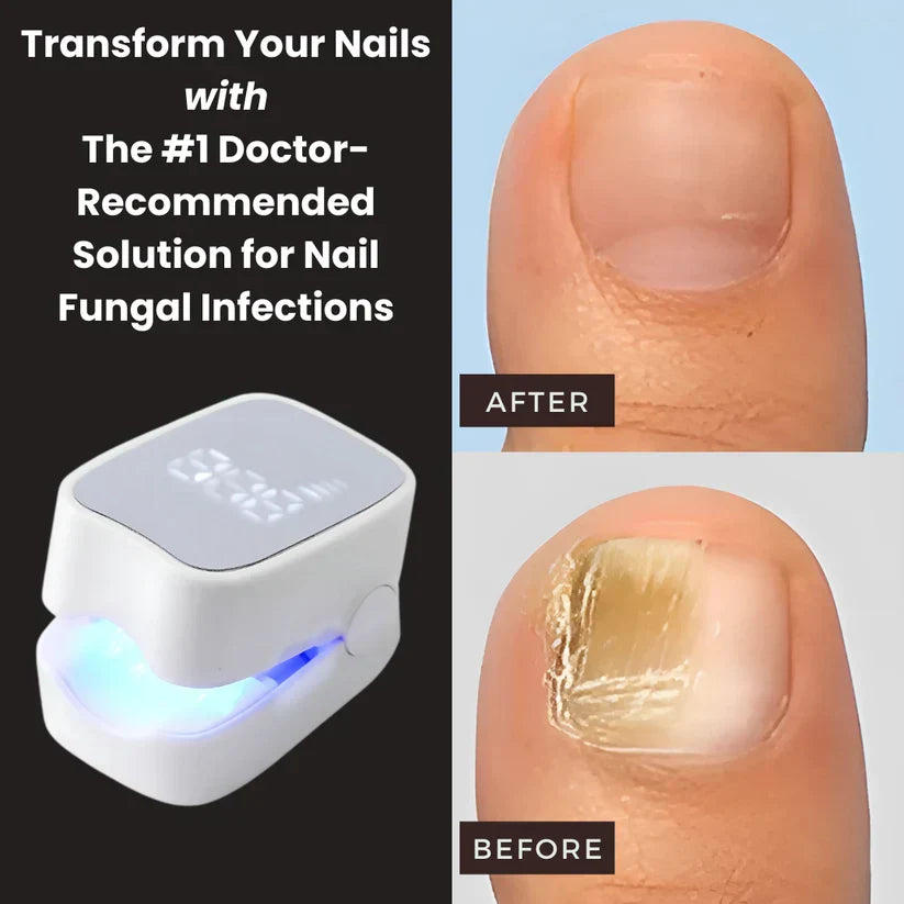 Walimo Pro™ - Nail Fungus Laser Device
