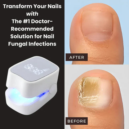 Walimo Pro™ - Nail Fungus Laser Device